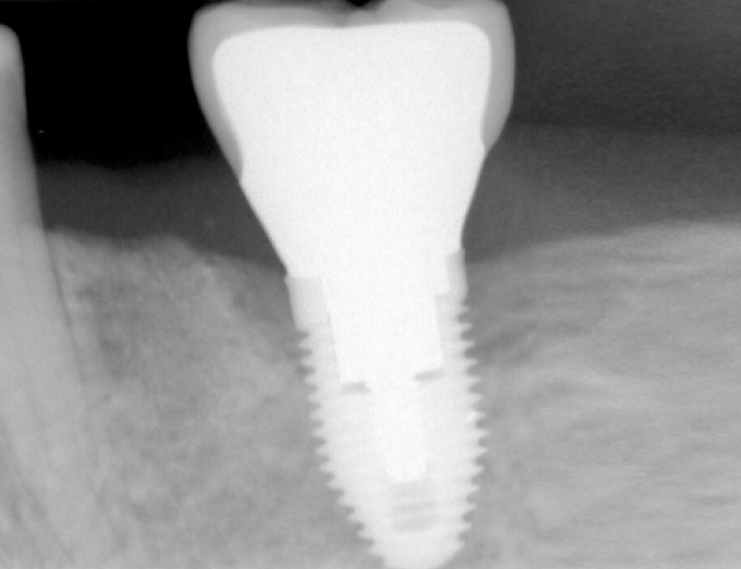 Dental Implant Diseases