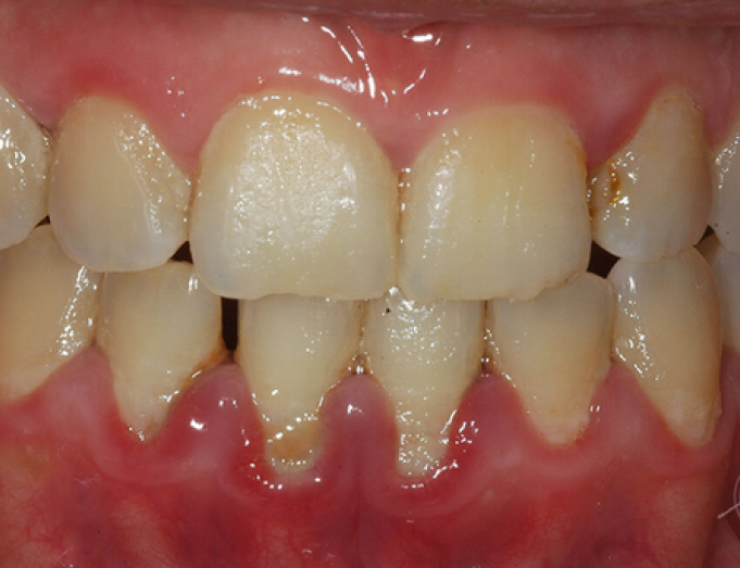 periodontal disease
