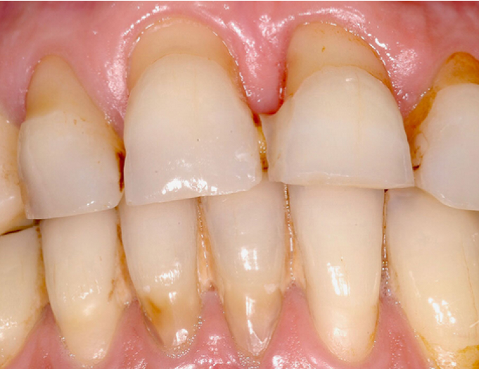 Periodontitis