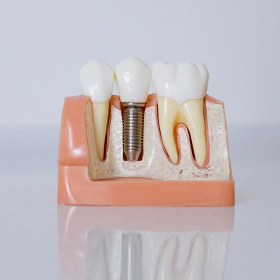dental implant disease