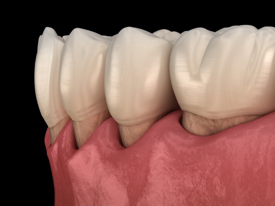 Periodontitis occurs as gum disease progresses