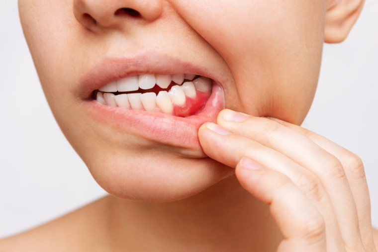 Signs Of Gum Disease
