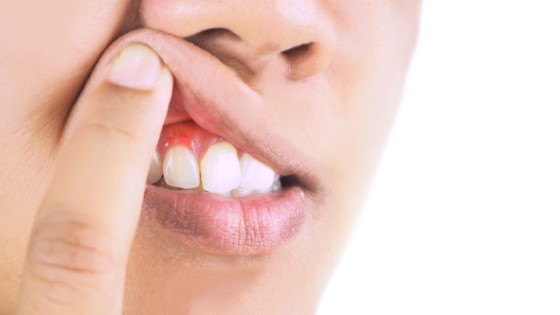 chronic periodontal abscess