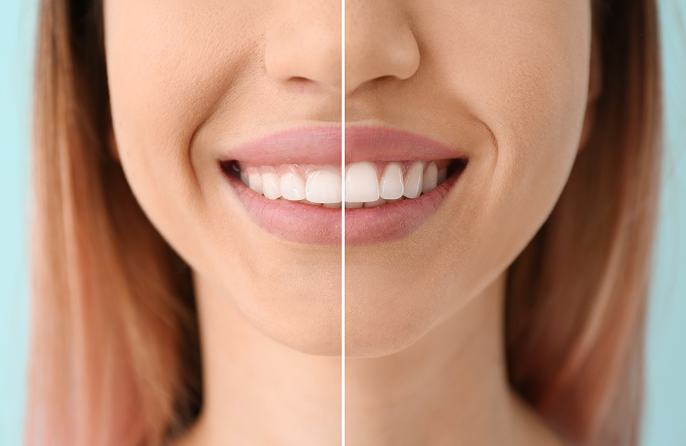 professional gum contouring