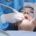Scaling and Root Planing & Periodontal Debridement