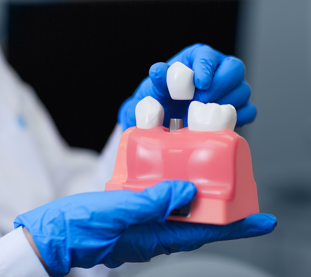 dental implants sydney