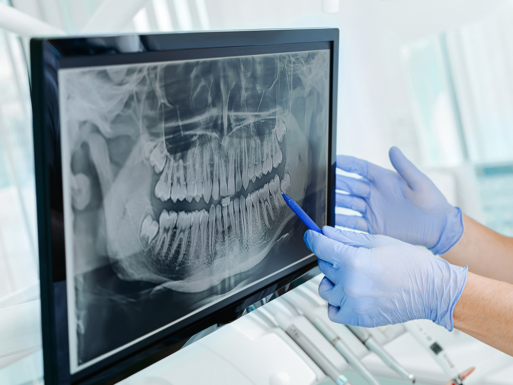 dental implants sydney